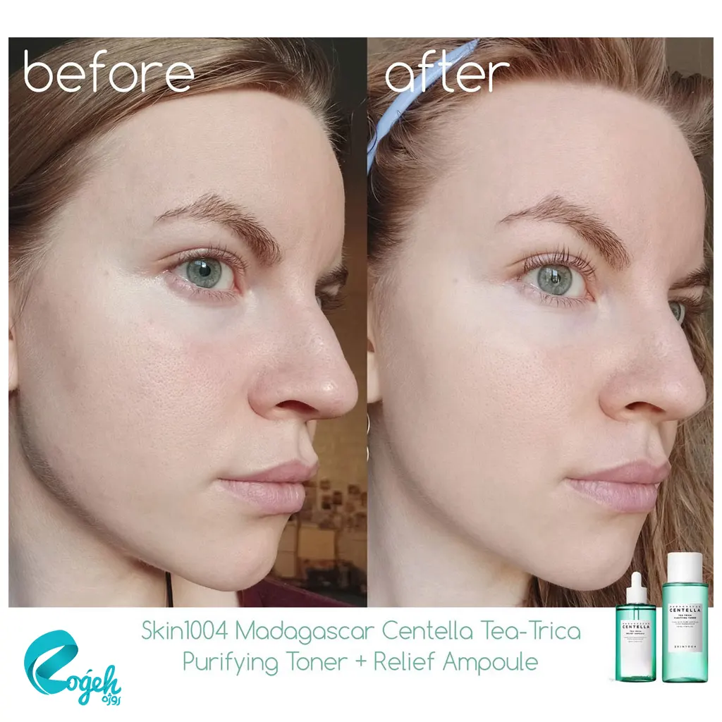 تونر پاککننده و متعادلکننده سنتلا ماداگاسکار Skin1004 مدل Tea-Trica